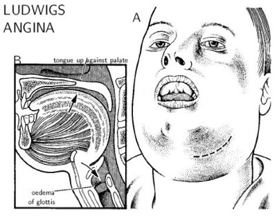 Ludwig's Angina 4