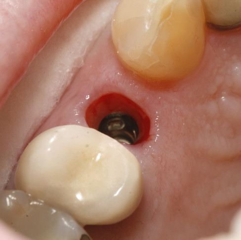 Dental implant with excellent healed soft tissue